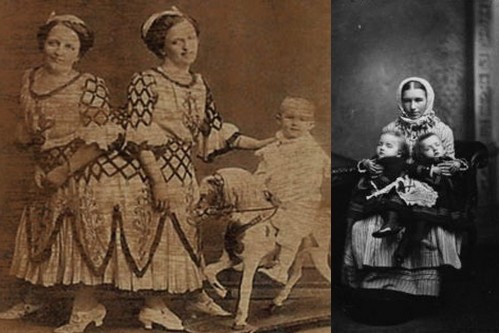 Rosa and Josepha Blažek Siamese Twins