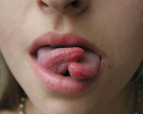Tongue Splitting