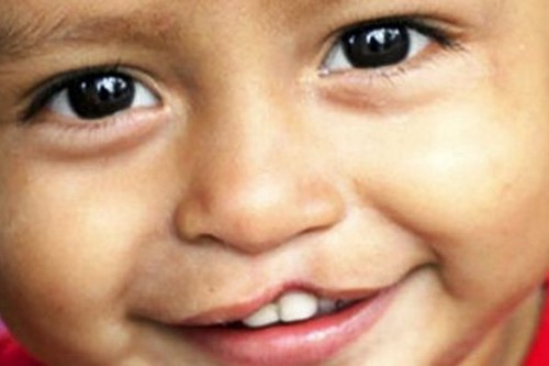 Hank recommends best of Charity treating facial deformities such deformities Charity such facial treating