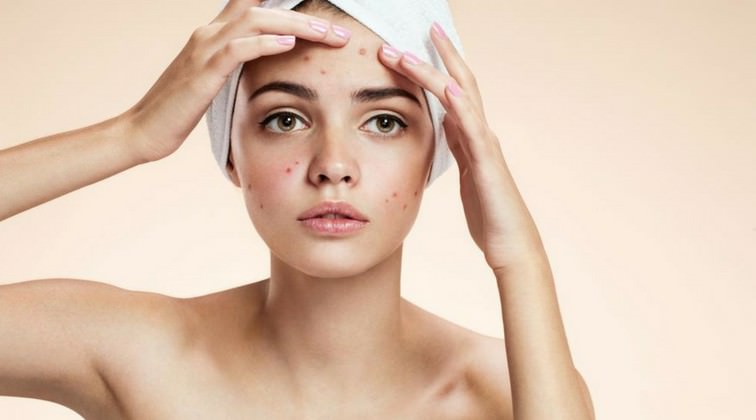 10 Effective Natural Remedies to Get Rid of Blackheads 11 Effective Natural Remedies to Get Rid of Blackheads