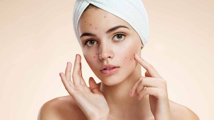 10 Natural Ways to Get Rid of Acne