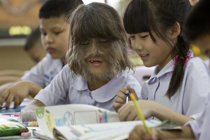 Supatra ‘Natty’ Sasuphan - World’s hairiest girl