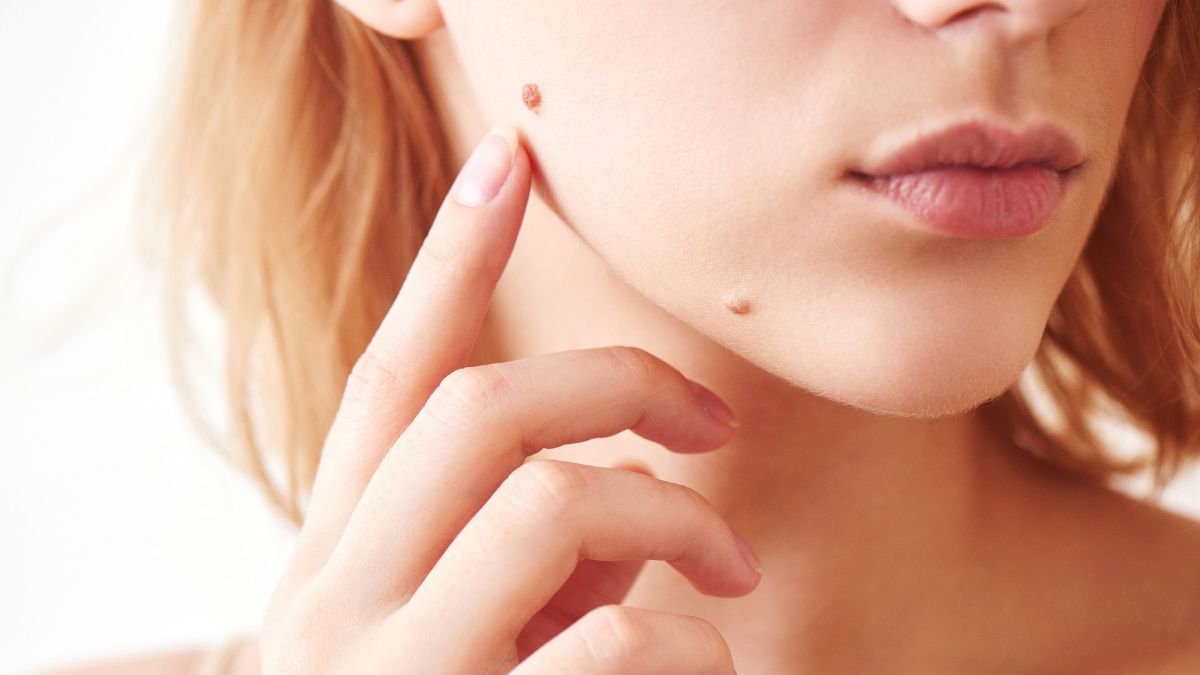 Beauty Benefits of Mole Removal